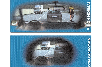 El glaucoma supone un grave peligro para la conducción